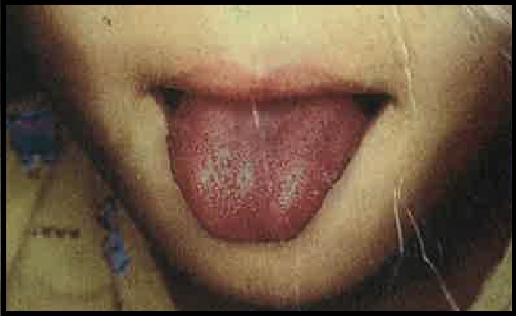 Strawbery Tongue