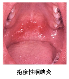 疱疹性咽峡炎
