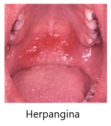 Herpangina