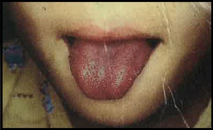 Strawberry Tongue