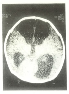 Computed tomography scan of the brain showing severe hydrocephalus