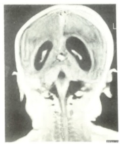 Magnetic resonance imaging study of the brain showing hydrocephalus